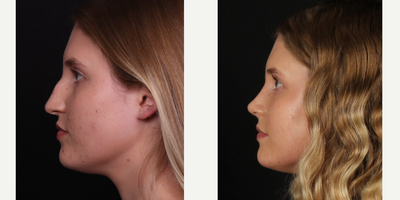 18-24 year old woman treated with Rhinoplasty - Female patient 5 weeks after rhinoplasty.