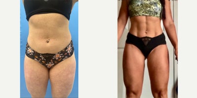 25-34 year old woman treated with Abdominal Etching, Laser Liposuction, Liposuction, Smart Lipo, Vaser Liposuction - Vaser Liposuction 360 with enhanced athletic contouring including inner thighs
