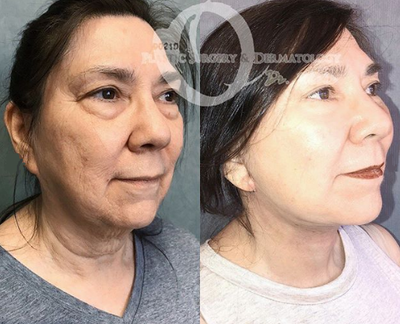Woman treated with Neck Lift - Woman treated with Neck Lift