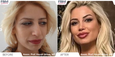 35-44 year old man treated with Rhinoplasty - .