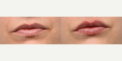 25-34 year old woman treated with Restylane Refyne, Restylane, Lip Fillers - For a subtle enhancement and a soft pout, NP Radhika Patel used Restylane Refyne on this patient's lips. Immediately after, her results are noticeable while still appearing natural.
