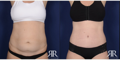 35-44 year old woman treated with Tummy Tuck - Tummy Tuck