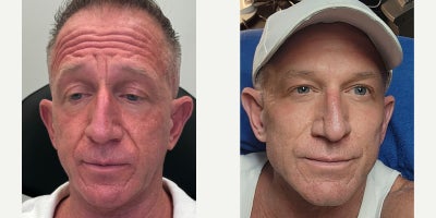 45-54 year old man treated with Nonsurgical Facelift - Nonsurgical facelift using dermal fillersBotox Jawline & enhancement using dermal fillers