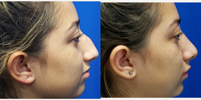 18-24 year old woman treated with Rhinoplasty - 18 year old female 6 weeks after a closed rhinoplasty and hump reduction. Her swelling will continue to improve over the year.