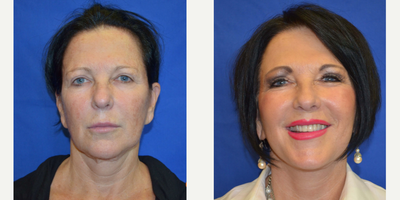 55-64 year old woman treated with Laser Treatment - This patient came to our practice wanting to rejuvenate her appearance for her career and personal life. After visiting with Dr. Ho, the patient elected to have a face/neck lift and laser skin resurfacing procedure.