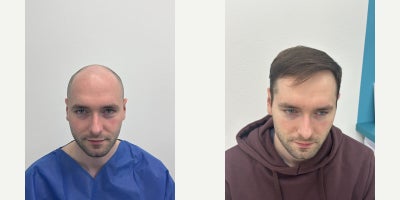 35-44 year old man treated with DHI Hair Transplant - A male patient aged 3544 presented with progressive frontal and temporal hair loss.Following an in-person consultation and medical assessment, a DHI hair transplant was selected as the most appropriate technique for his hair characteristics and stage of hair loss.The procedure was performed by the medical team under physician supervision, with careful planning of graft placement to achieve a natural hairline and balanced density.Photos were taken 9 months post-procedure, showing continued maturation of the result and stable hair growth. Healing progressed without complications, and the patient followed a structured post-treatment and follow-up protocol.This case reflects a conservative, patient-focused approach aimed at natural-looking, long-term outcomes.