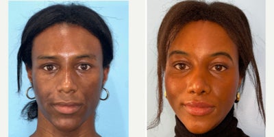 25-34 year old transgender woman treated with Facial Feminization Surgery - Hairline advancement, frontal sinus setback, orbital contouring, rhinoplasty, lip lift, reduction genioplasty, mandibular angle reduction, chondrolaryngoplasty, and fat grafting to the lips and cheeks.