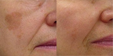 Laser Peel