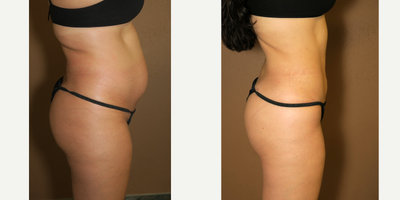 25-34 year old woman treated with Liposuction - liposuction
