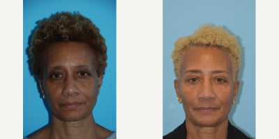 55-64 year old woman treated with Eyelid Surgery, Neo Laser, Dermal Fillers, Botox, Morpheus8 - This patient is shown 6 years after her initial photo. She underwent neurotoxin, filler to the midface, morpheus skin tightening, aerolase neo treatments, microneedling, hydrafacials and regular skin care use. Additionally, she is shown 1 month after upper blepharoplasty. Looking the like herself but has aged backwards.