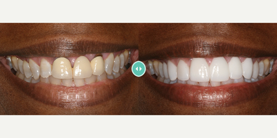Woman treated with Porcelain Veneers - Woman treated with Porcelain Veneers