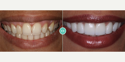 Woman treated with Porcelain Veneers - Woman treated with Porcelain Veneers