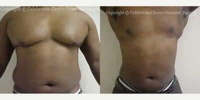 Man treated with Gynecomastia Surgery - Man treated with Gynecomastia Surgery and Liposculpture, shown 3 months post op.