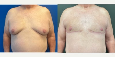 65-74 year old man treated with free nipple Gynecomastia surgery - At 71, standing 5'9 and 245 pounds, he achieved a flatter, more masculine chest with gynecomastia surgery using free nipple grafting. The result is a smooth, contoured chest with improved definition, symmetry, and a rejuvenated, natural appearance.