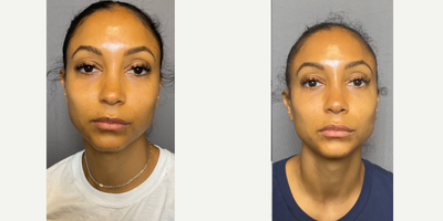 35-44 year old woman treated with Restylane, Restylane Lyft, Dermal Fillers, Cheek Lift - Under eye filler