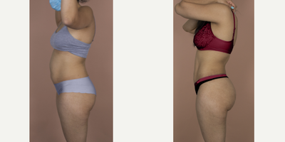 25-34 year old woman treated with Brazilian Butt Lift & Hi-Def Liposuction - This is a young mother who wanted to reclaim her youthful body, which had changed significantly after pregnancy. She wanted to look more athletic and have a fuller buttock. She underwent a 360Lipo with Vaser Hi-Def sculpting and fat transfer. Now, she can't stop showing off her beach body!