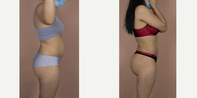 25-34 year old woman treated with Brazilian Butt Lift & Hi-Def Liposuction - This is a young mother who wanted to reclaim her youthful body, which had changed significantly after pregnancy. She wanted to look more athletic and have a fuller buttock. She underwent a 360Lipo with Vaser Hi-Def sculpting and fat transfer. Now, she can't stop showing off her beach body!