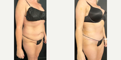 45-54 year old woman treated with Diastasis Recti Repair, Liposuction - The patient presented for a tummy tuck and liposuction of the flanks, abdomen, and upper and lower back.