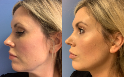 25-34 year old woman treated with Restylane - This patient was treated with a total of 3 syringes of filler. 1 in each cheek and 1 for the lips.