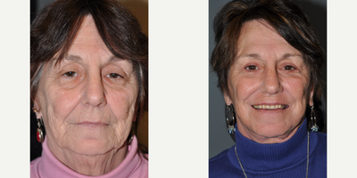 65-74 year old woman treated with Facelift - This patient had a Full Face and Neck Lift as well as an upper and lower eyelid Blepharoplasty.