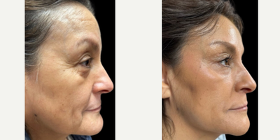55-64 year old woman treated with Dermal Fillers, PRP Injections - AUTOCORRE HD at Omni Aesthetics. Combining PBF Gel with fillers to create a smoother skin surface, and a more lifted and brighter appearance.