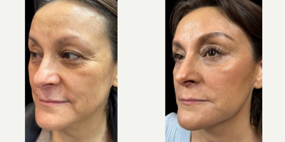 55-64 year old woman treated with Dermal Fillers, PRP Injections - AUTOCORRE HD at Omni Aesthetics. Combining PBF Gel with fillers to create a smoother skin surface, and a more lifted and brighter appearance.
