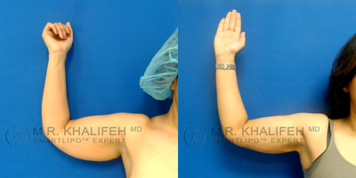 25-34 year old woman treated with Tumescent Liposuction - Awake smartlipo patient undergoing arm sculpting with laser lipolysis followed by liposuction.