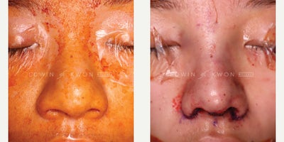 18-24 year old woman treated with Asian Rhinoplasty, DCF Rhinoplasty and Alar Base Reduction - 18-24 year old woman treated with DCF rhinoplasty and alar base reduction. The patients main concerns regarding her nose was that it appeared very flat and wide. She was seeking a more feminine and slimmer appearing nose. Her nasal bridge was better defined with dorsal aesthetics lines created with a DCF graft. Her lack of bridge height also made her nose appear shorter overall. Augmenting the bridge including the radix area gave her nose an overall longer appearance to match her midface. The nasal tip was refined with soft tissue debulking, cephalic trim, lower lateral cartilage repositioning, and increased nasal tip height. This had given her nose a narrower appearance overall but was capped off with alar base reduction to help decrease the flaring of the alas as well as provide a slimmer appearing nose overall.