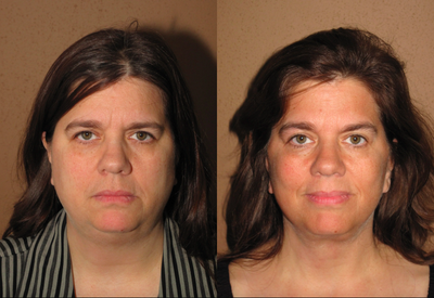 Facial rejuvenation facelift mid face lift endobrow - Facial rejuvenation and beautifying procedure which included endoscopic brow lift, blepharoplasty, mid-face lift and face/neck lift