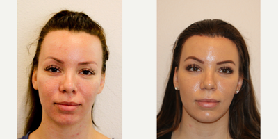 25-34 year old woman treated with Forehead Reduction - This 29-year-old pleasant female presents with a chief complaint of a long four head. The patient is displeased with her forehead length beginning at her hairline and extending to her eyebrow. In the after photo shown here, she is three months post forehead reduction surgery. This was performed in the office based setting using using primarily local anesthesia. Orally taken, anxiety reducing medication, was also used for comfort. A trans follicular (hair sparing) pretrichial (within the first few hairs of the front of the hairline) incisional approach is required obtain the desired result. Deeper sedation or even general anesthesia is available for appropriate patients or patients requesting this type of anesthesia.