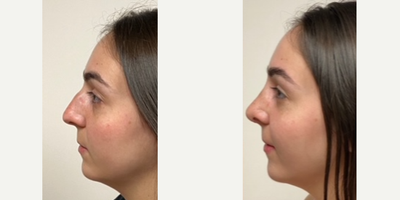 25-34 year old woman treated with Rhinoplasty - 1 month after a rhinoplasty