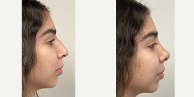 18-24 year old woman treated with Rhinoplasty - 22 days after a rhinoplasty