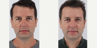 45-54 year old man treated with BroadBand Light (BBL) - Before and after 1 BBL treatment to address sun damage and uneven skin tone. Patient will receive two more treatments.