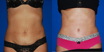 Tummy Tuck -
Tummy Tuck