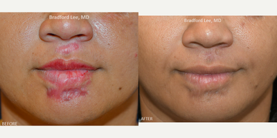25-34 year old woman treated with Laser Resurfacing, CO2 Laser, Scar Removal - This 20+ year old female presented with scars around her lips that was causing disfigurement, tightness, and pain. She had 4 sessions of CO2 laser resurfacing with scar injections to help flatten and improve the quality and mobility of the skin.