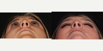 17 or under year old woman treated with Rhinoplasty - Rhinoplasty B&A