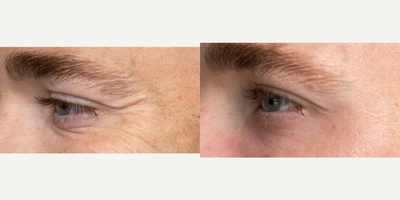 25-34 year old man treated with Plasma Pen - 10 days post op plasma pen to lower lids.