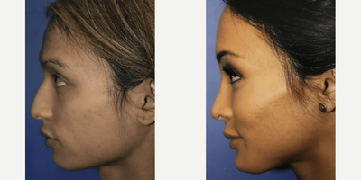 Woman treated with Jaw Reduction - Woman treated with Jaw Reduction