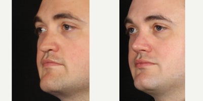 25-34 year old man treated with Rhinoplasty - One month ago our patient underwent a rhinoplasty to straighten the bridge and rotate the tip of his nose. We used piezo technology to swing the bridge towards the midline with less bruising and swelling. So far the symmetry is improved and he is breathing a lot better. We are so pleased with the progress and appreciate him allowing us to share his photos.