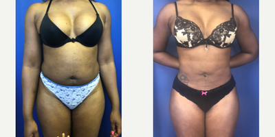 25-34 year old woman treated with Tumescent Liposuction - A woman in her early 30s is shown 5 months after liposuction.