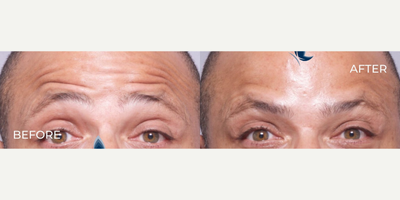 Man treated with Botox - Man treated with Botox