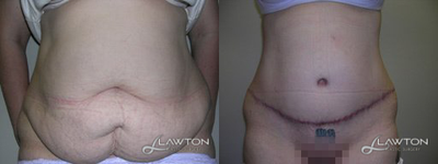 Tummy Tuck - Follow-Up: 5 Months