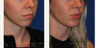 18-24 year old woman treated with Lip Fillers, Chin Implant - Patient wanted a chin implant to create a more symmetrical look.
