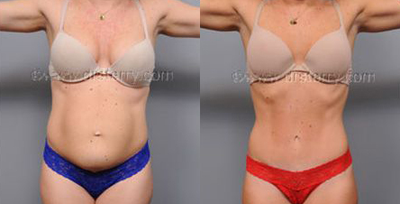 Tummy Tuck and Hernia Repair - This 34 year old woman came in asking for a tummy tuck. She was 5 feet 6 inches tall and had a weight of 125 lbs. She developed a hernia after a previous C-section and needed to have her abdominal muscles put back in their proper place. A tummy tuck was done at the same time as the hernia was repaired. Note that the skin surrounding her umbilicus has moved and there is a fine tummy scar in the area. Furthermore, the umbilical hernia has been repaired and her belly button has a more refined shape.