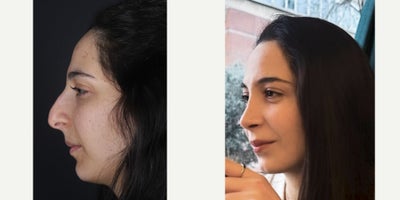 25-34 year old woman treated with Rhinoplasty - Our lovely patient from Belgium. As you can see in Before picture; she has hooked and droopy nose. After Ultrasonic Piezo + Power Assisted Burr Rhinoplasty technique; she met with her dream nose!