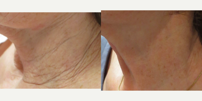 55-64 year old woman treated with Ultherapy - Treated with PRP injections combined with Ultherapy on the neck