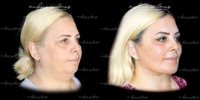 45-54 year old woman treated with Deep Plane Facelift, Neck Lift, Chin Implant, Buccal Fat Removal - This 45-54-year-old patient underwent a combination of Deep Plane Facelift, Neck Lift, Chin Implant, and Buccal Fat Removal to achieve a harmonious and rejuvenated facial appearance. The Deep Plane Facelift lifted and redefined the deeper facial tissues, restoring youthful contours. The Neck Lift addressed sagging skin and created a smoother neck profile, while the Chin Implant enhanced chin projection for a more balanced facial structure. Buccal Fat Removal further refined her mid-face by reducing fullness, resulting in a slimmer and more sculpted look. At 6 months post-operative, the patients results highlight the natural-looking and transformative outcomes achieved through these combined procedures, enhancing her confidence and overall appearance.