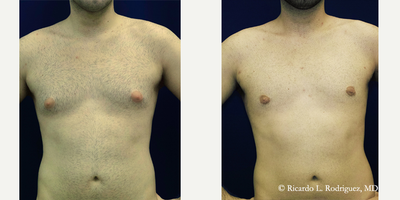 35-44 year old man treated with Gynecomastia Surgery - This 39 year old man elected to have Gynecomastia Surgery (also referred to as a male breast reduction) (2-7 days)