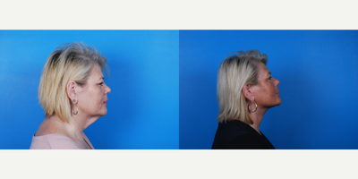 45-54 year old woman treated with Facelift - This 54 year old female had a Facelift and 3 Morpheus8 treatments to her face and neck.