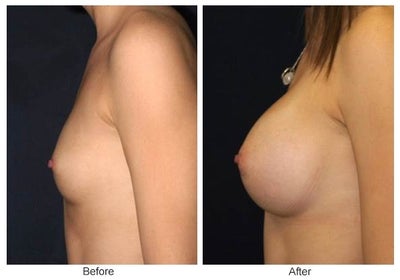 Cost Of Breast Augmentation In Ks Mo 117